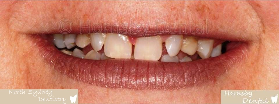 North_Sydney_Dental_Care_Veneer_Case_04-Before