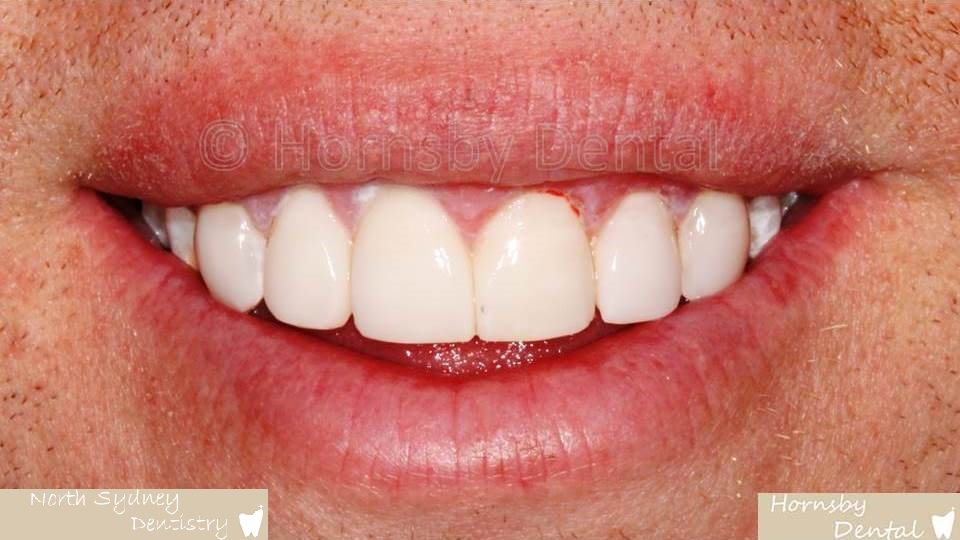 North_Sydney_Dental_Care_Veneer_Case_05-After