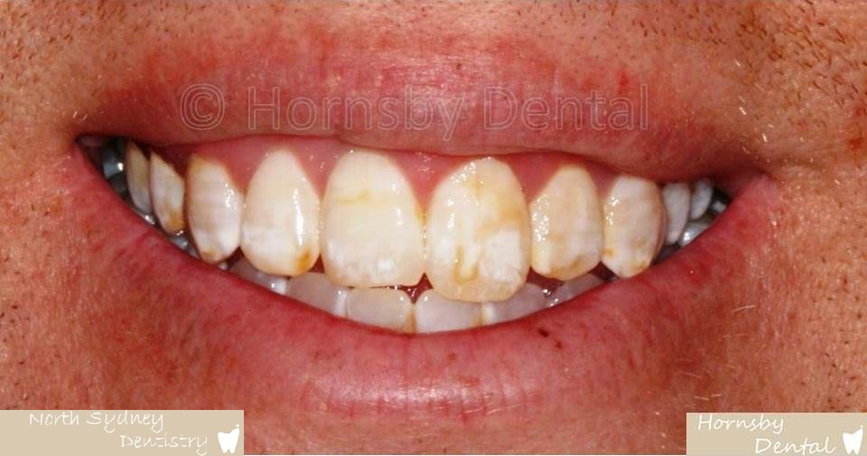 North_Sydney_Dental_Care_Veneer_Case_05-Before