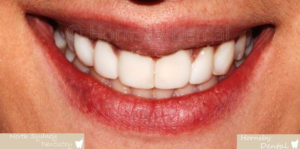 North_Sydney_Dental_Care_Veneer_Case_06-After