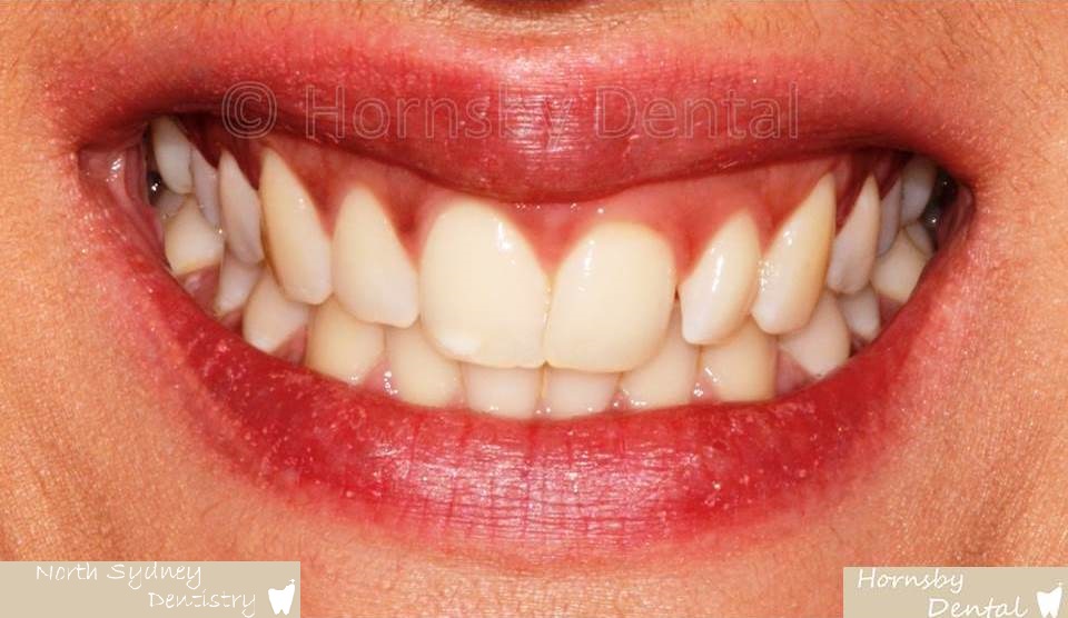 North_Sydney_Dental_Care_Veneer_Case_06-Before