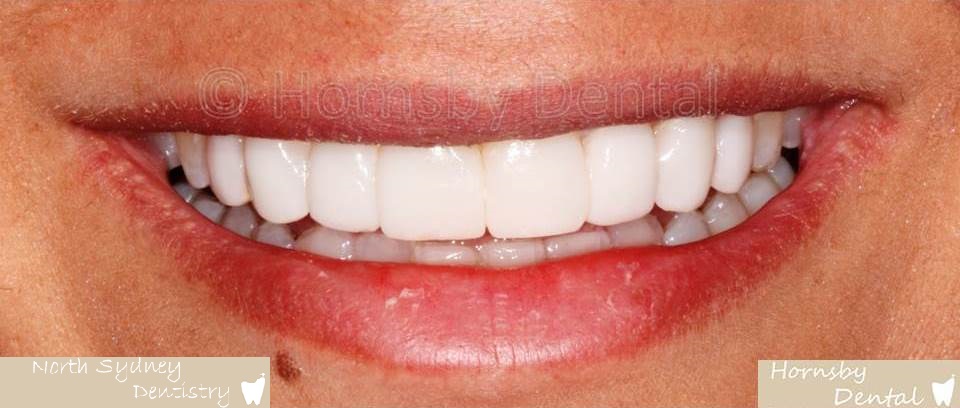 North_Sydney_Dental_Care_Veneer_Case_07-After