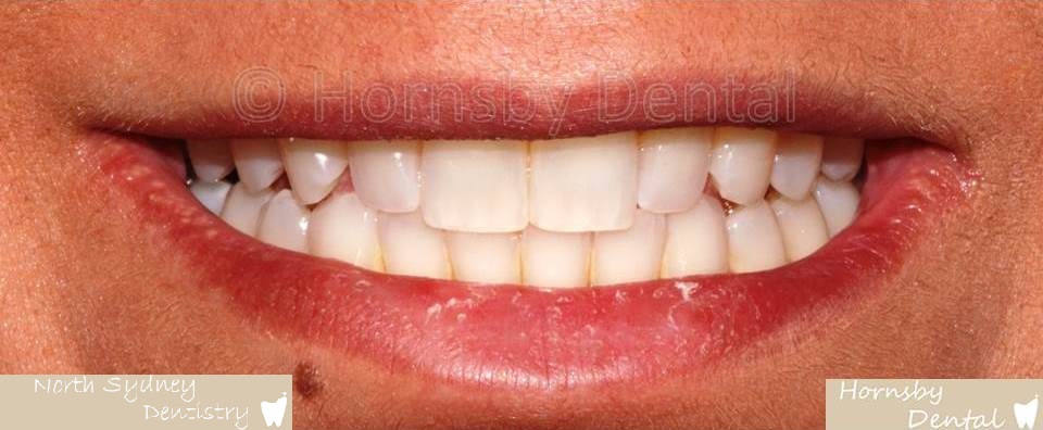 North_Sydney_Dental_Care_Veneer_Case_07-Before