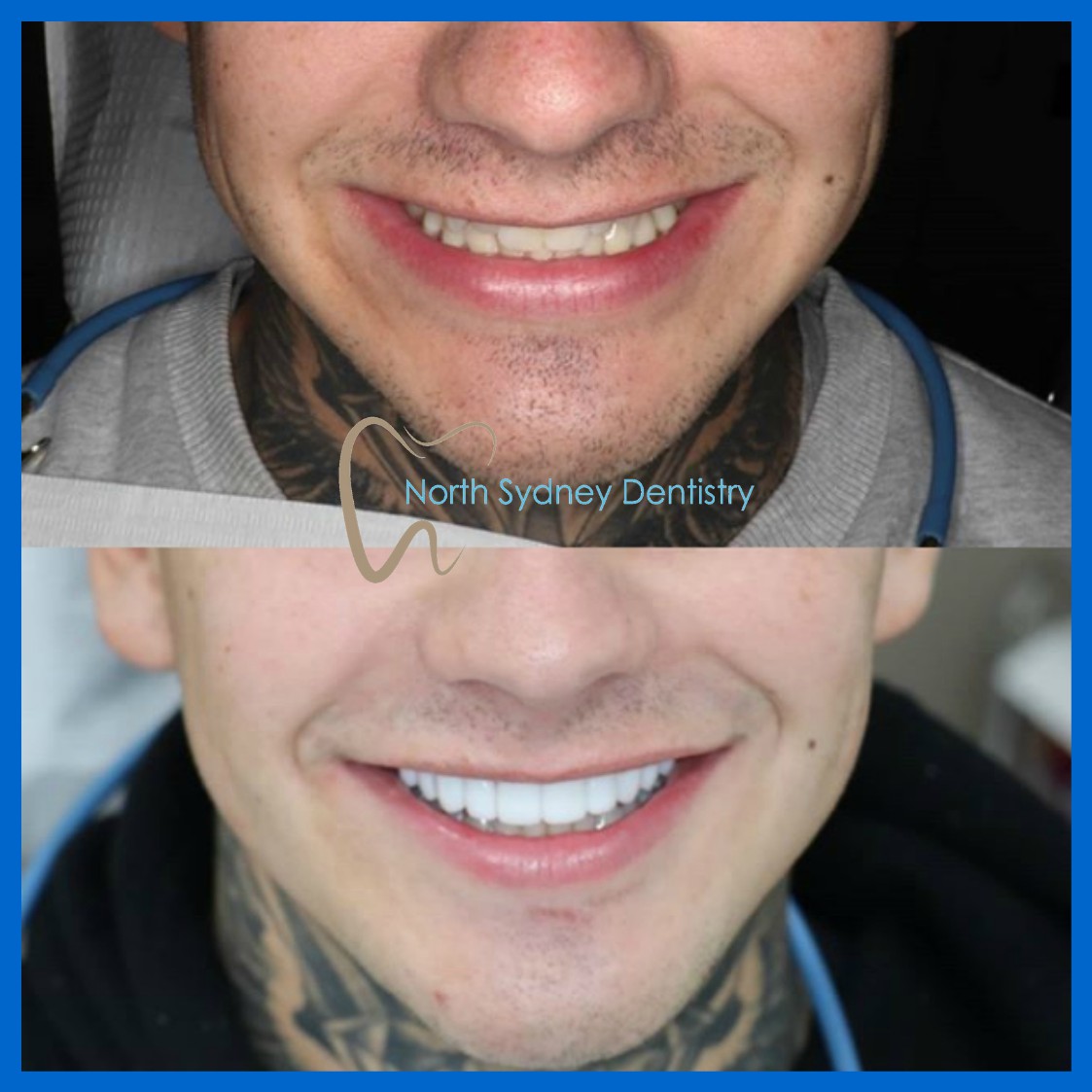 Veneers in North Sydney