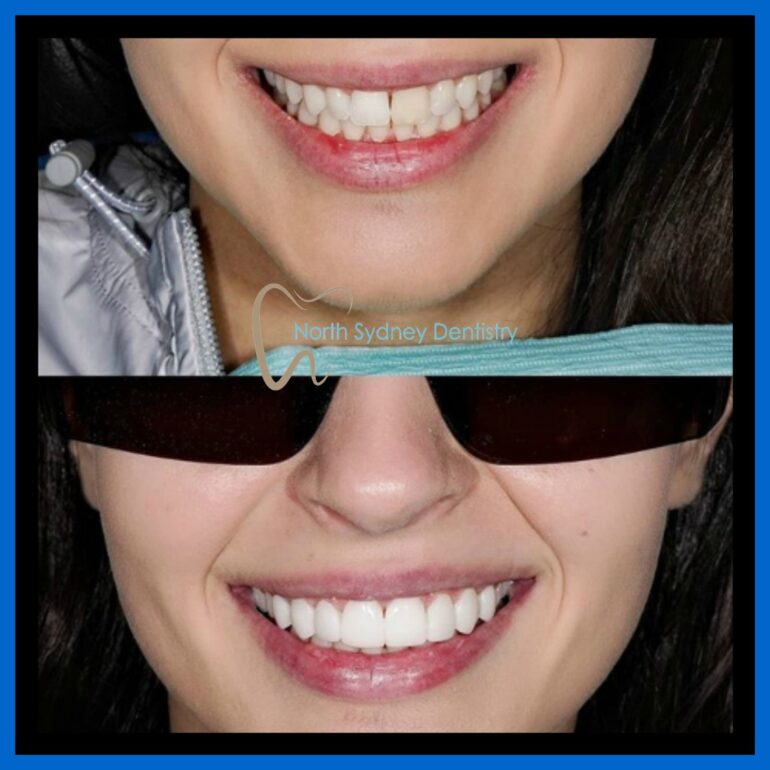 Dental Veneers North Sydney Dentistry