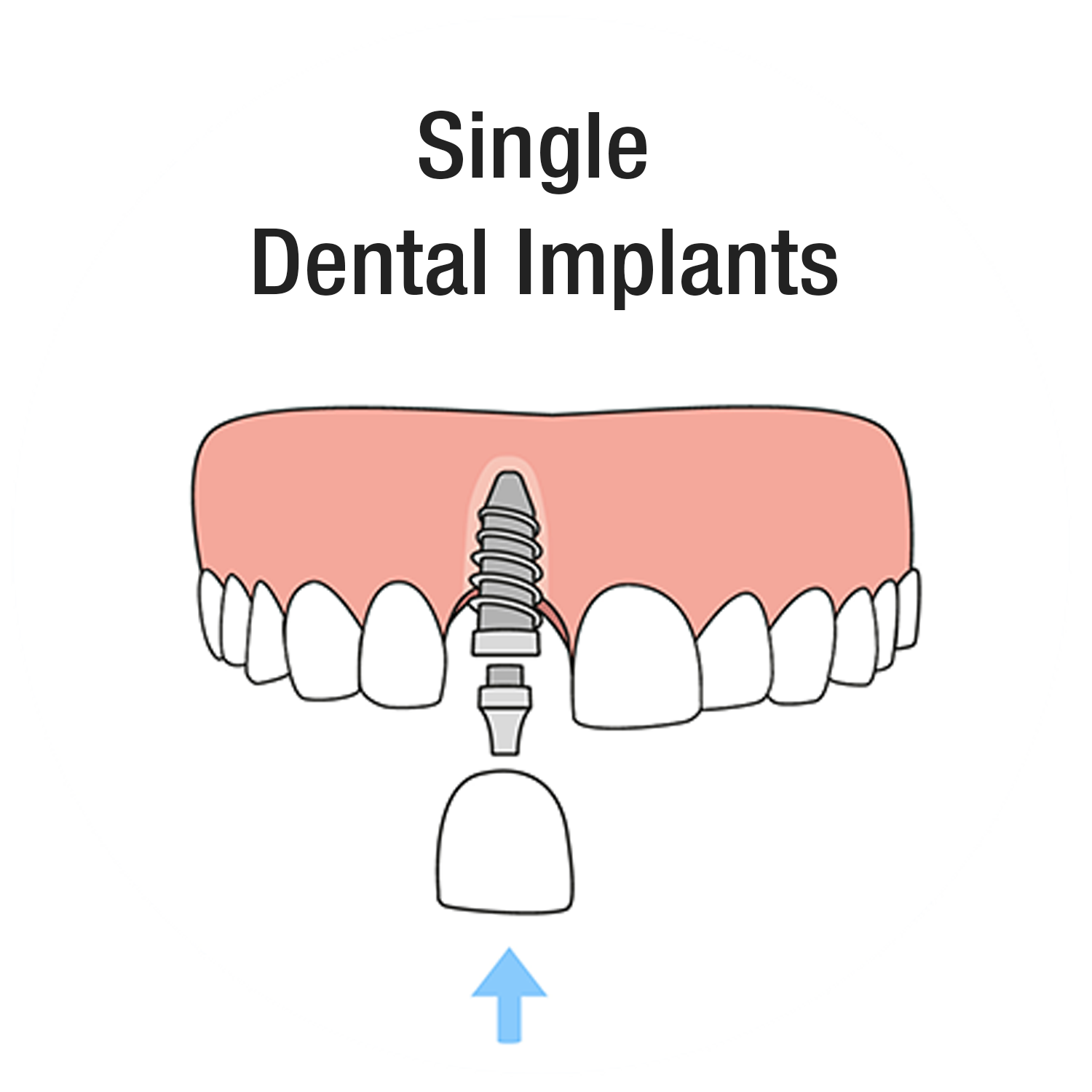 Single-Dental-Implants