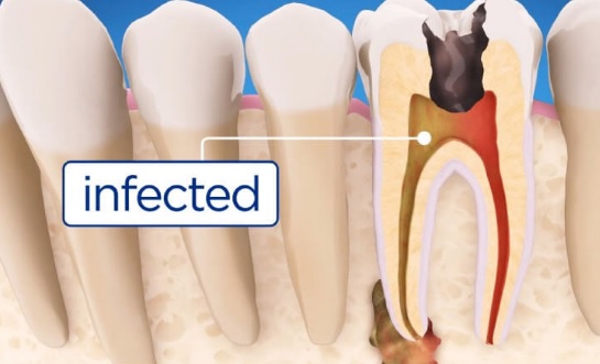 Root Canal Cost Sydney