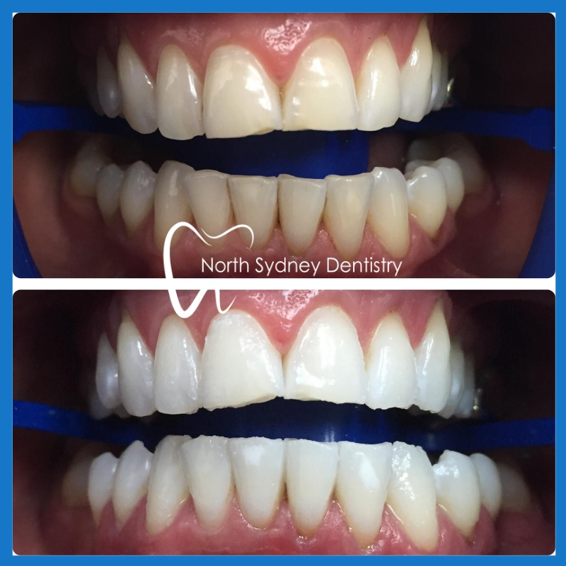 Teeth whitening in North Sydney