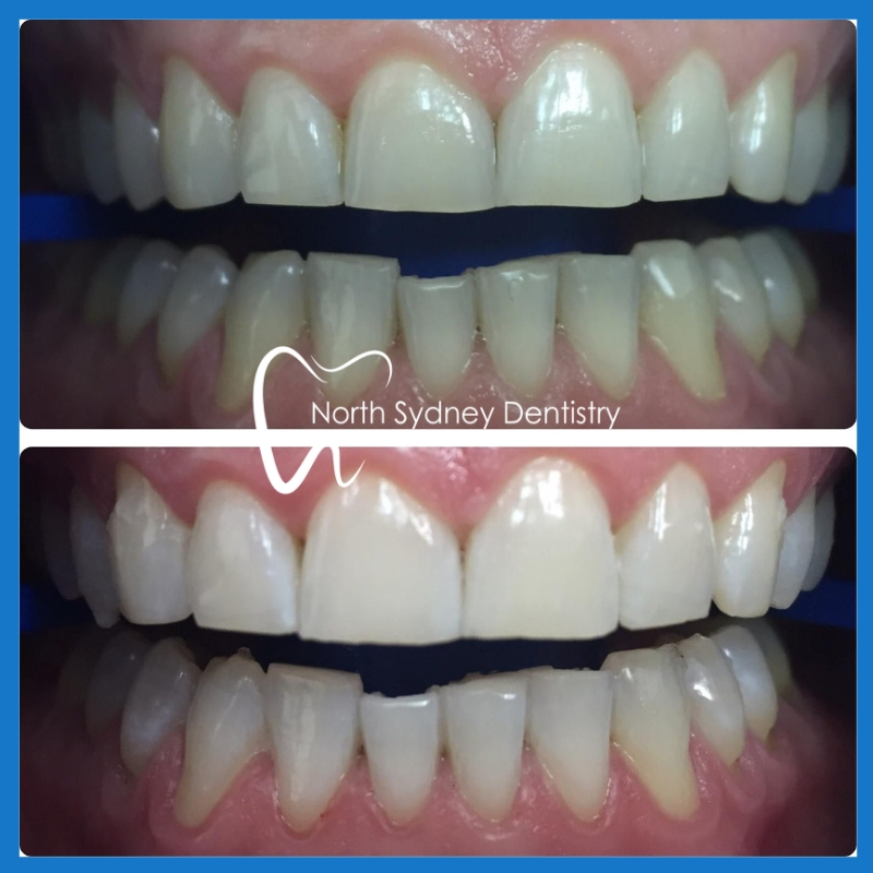 Best teeth whitening in North Sydney