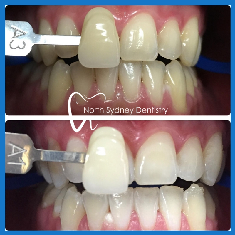 Affordable teeth whitening in North Sydney