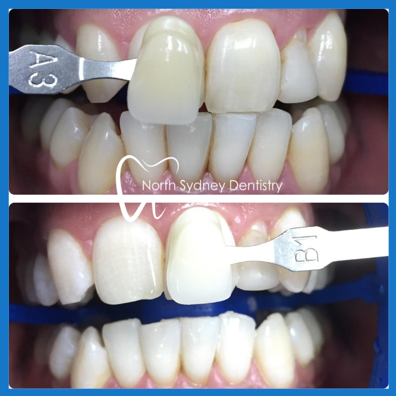 Teeth whitening in North Sydney