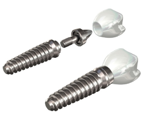 Titanium Dental Implants in North Sydney