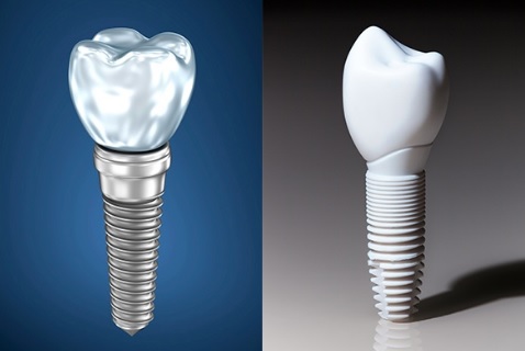 Types of dental implants available in North Sydney