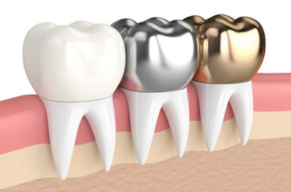 Dental Crown Cost