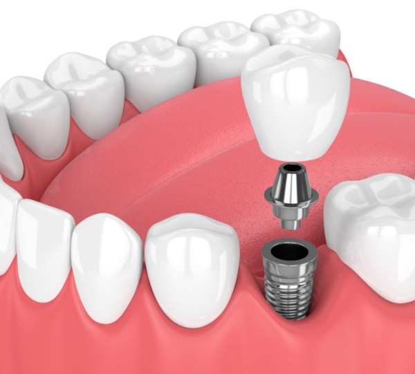 Dental implant surgery in North Sydney