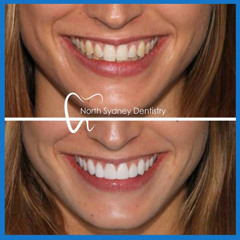 Veneers in North Sydney