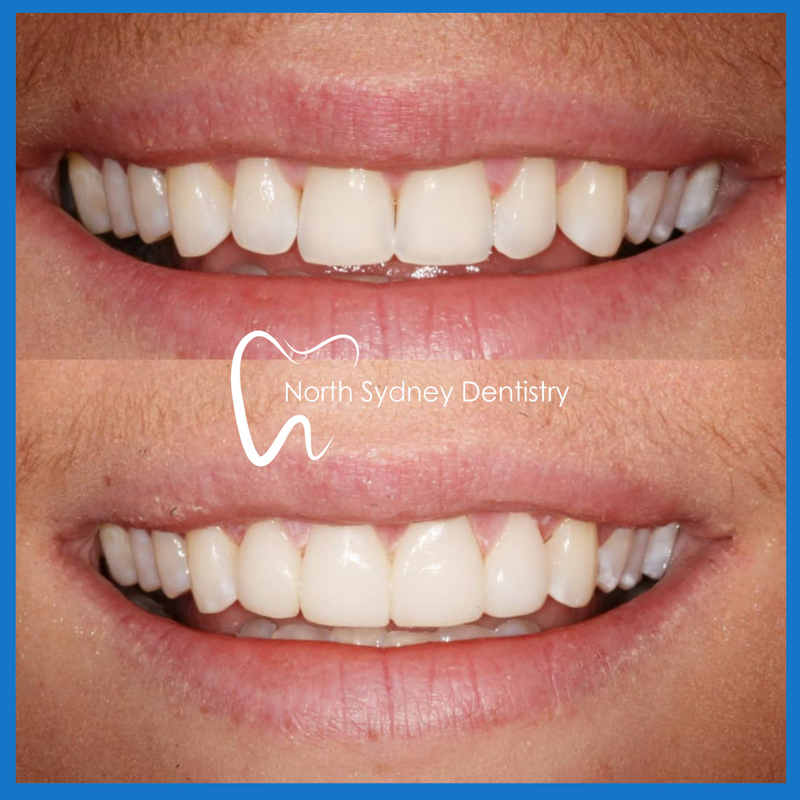 Best veneers in North Sydney