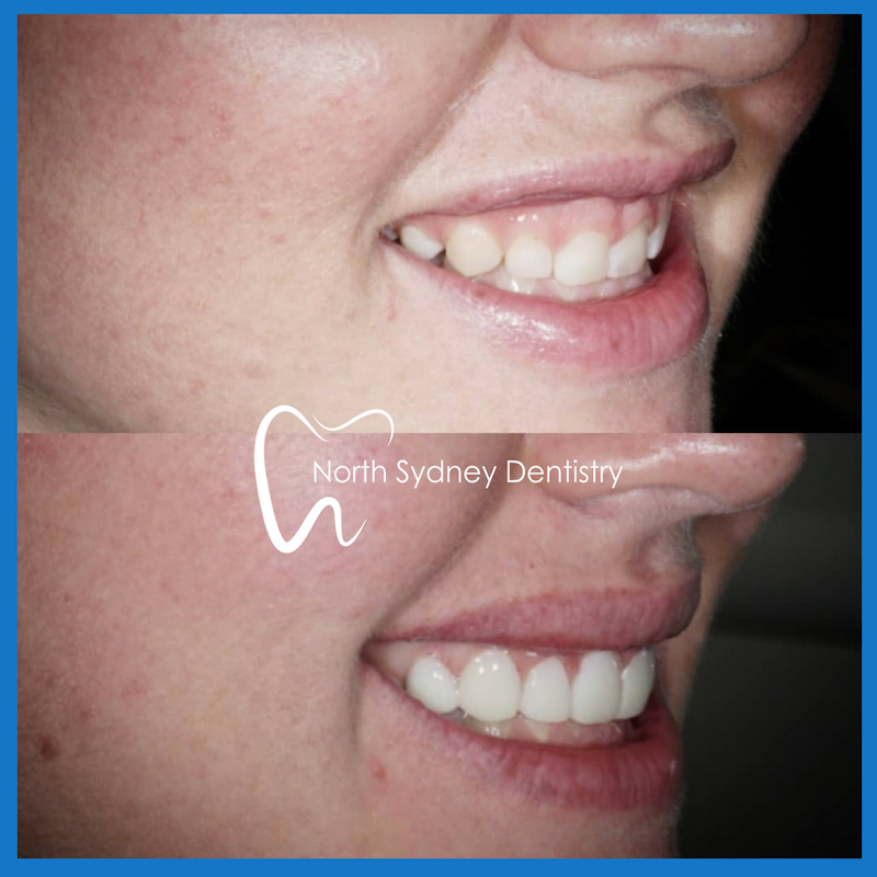 Veneers in North Sydney