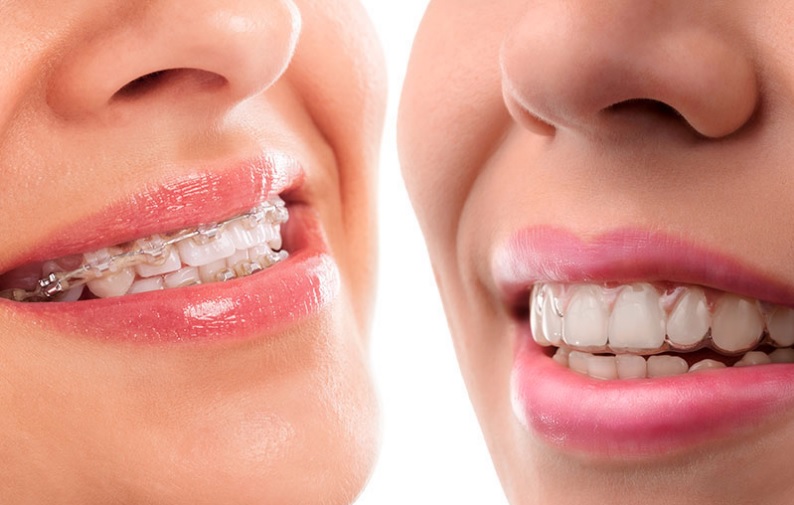 Invisalign vs braces cost in North Sydney