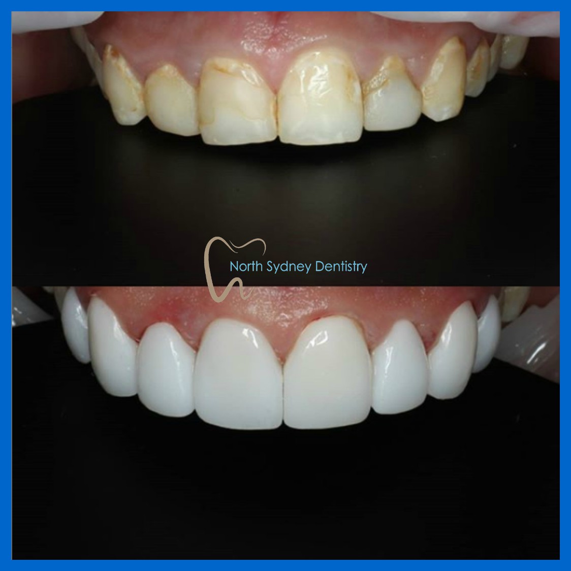 Veneers in North Sydney