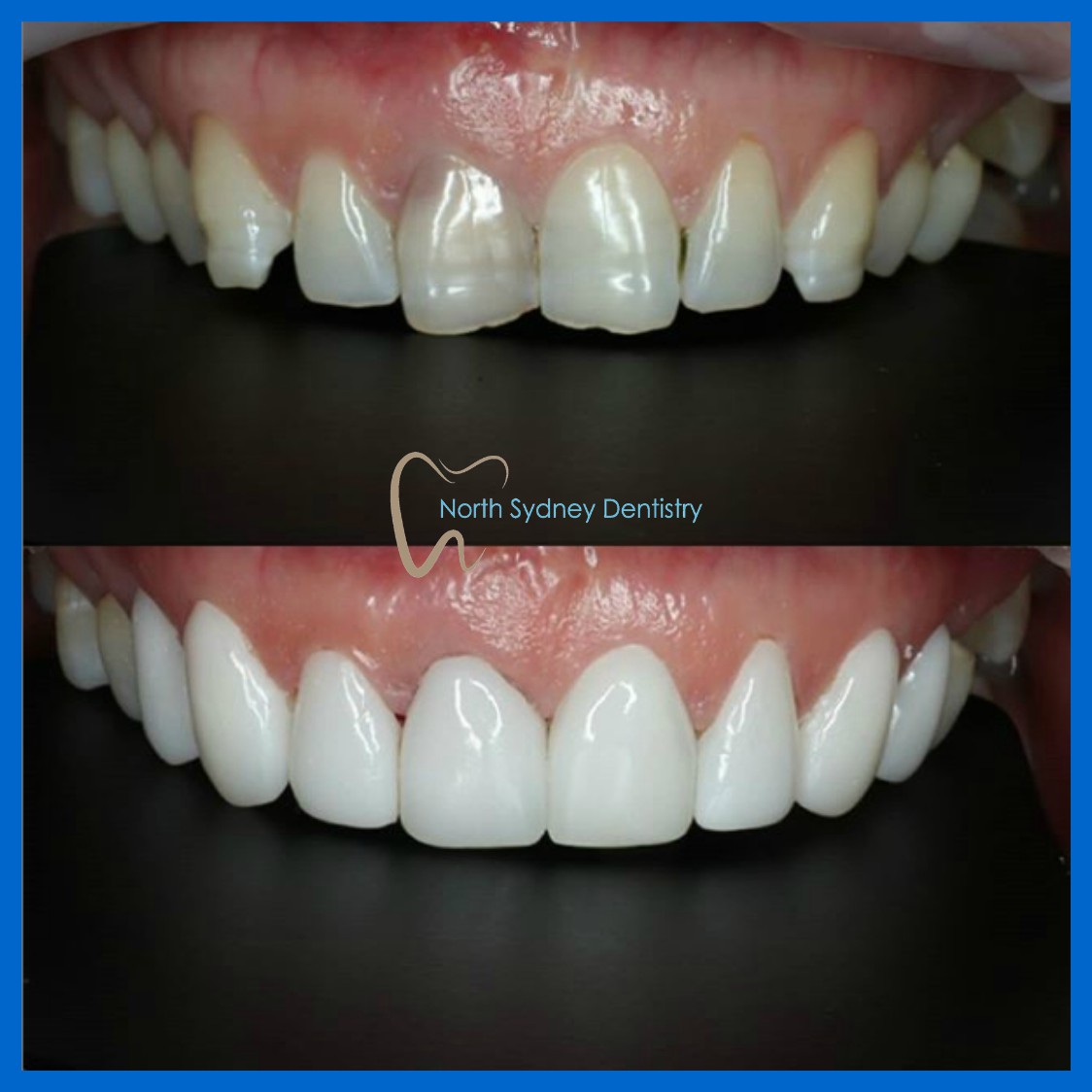 Best dental veneers in North Sydney