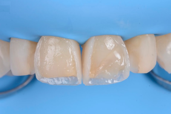 composite veneers sydney