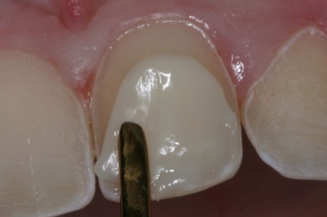 composite veneers in Sydney