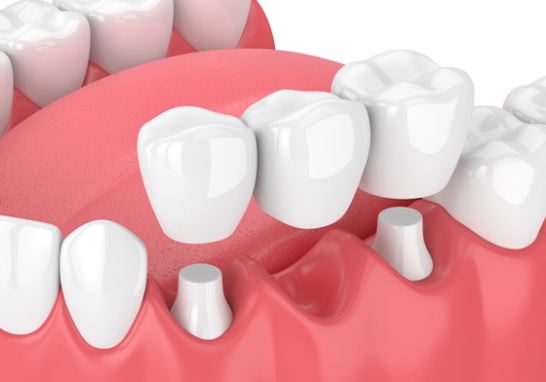 Dental Bridge cost