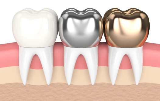 Dental Crown in Sydney