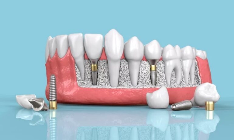 dental implants sydney
