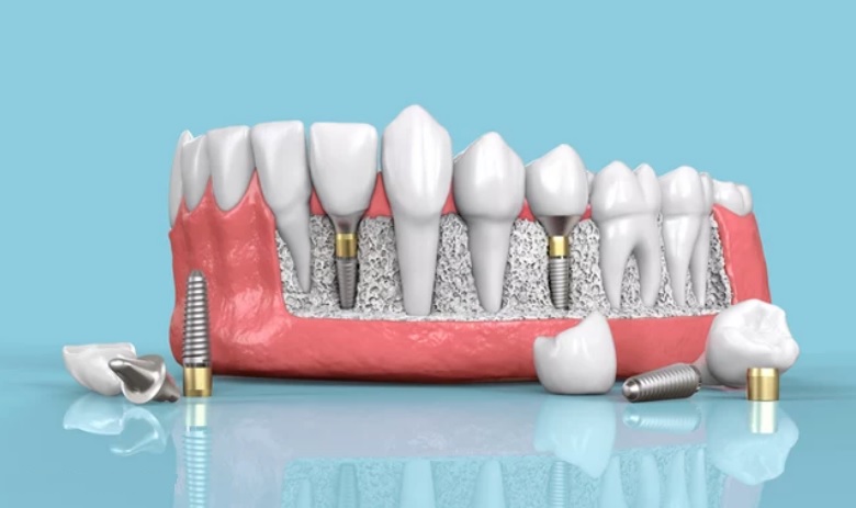 dental implants sydney