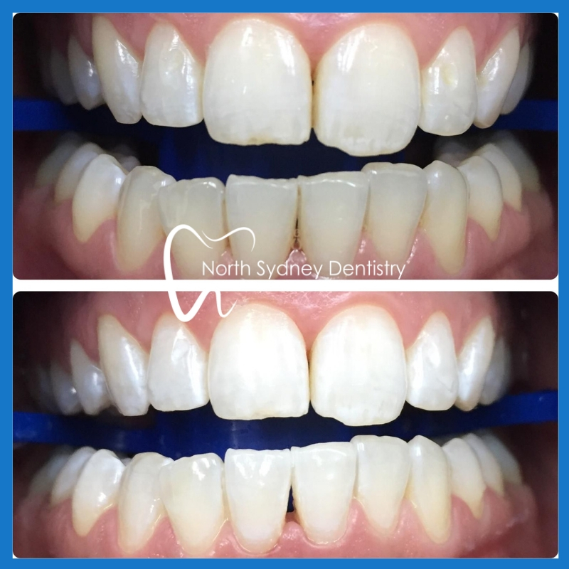 Best dentist for teeth whitening in North Sydney