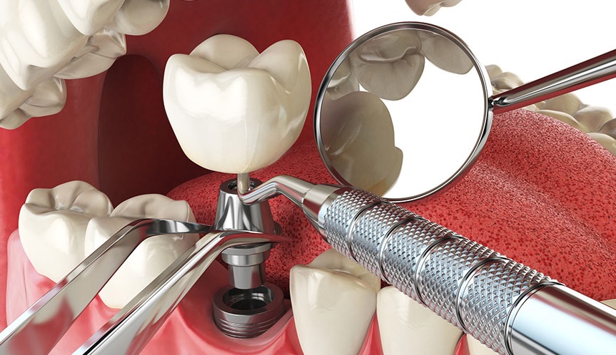 durability of dental implants in North Sydney