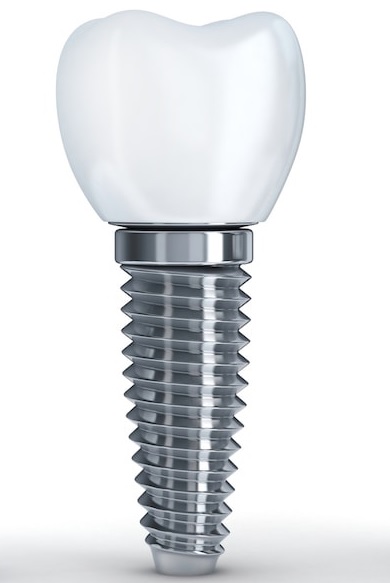 durability of dental implants in North Sydney