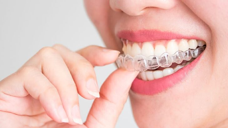 Invisalign in Sydney