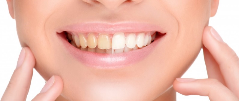 Best teeth whitening in north sydney