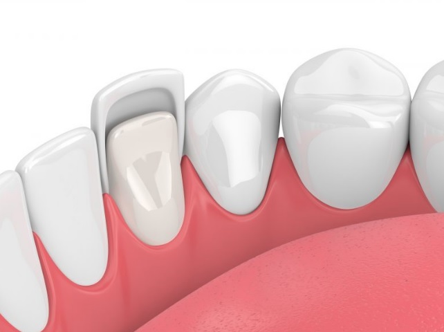 porcelain veneers sydney