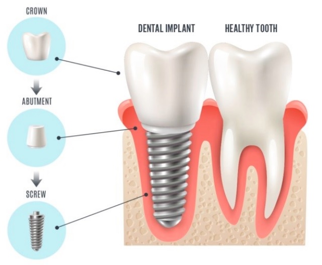 dental implants sydney