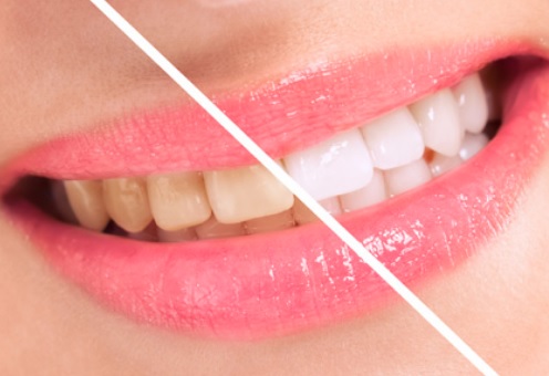 teeth whitening in sydney