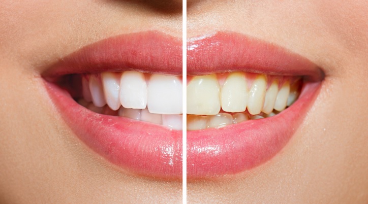 Teeth Whitening in North Sydney