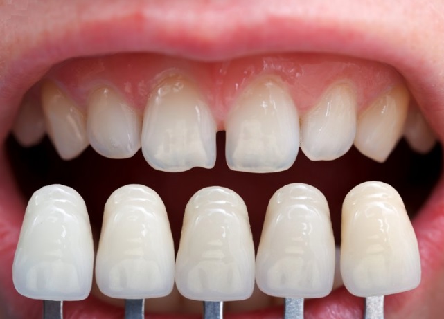 are veneers worth it?